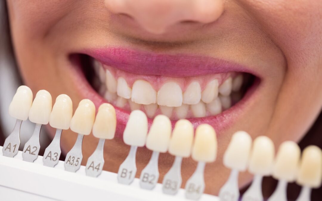 Zahnbleaching – Natürlich weiße Zähne für ein strahlendes Lächeln